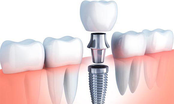 Como-se-colocan-los-implantes-dentales