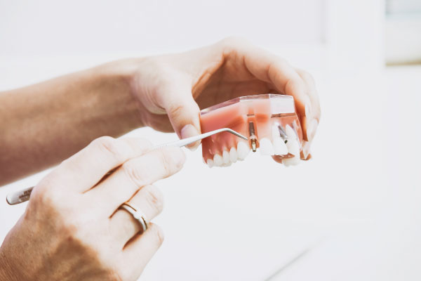 Implantes Cigomaticos - Zen Dental 1