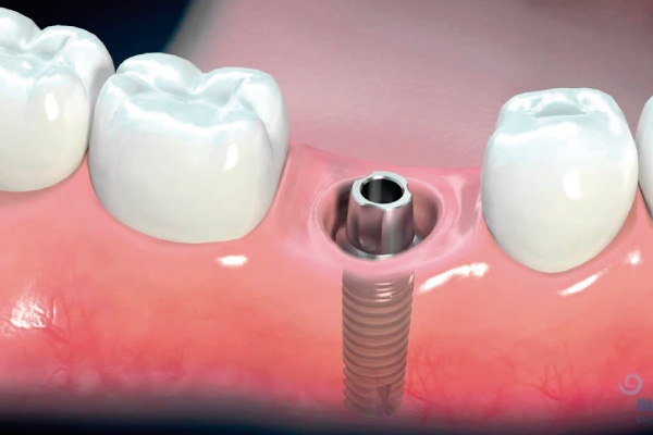 Implantes dentales - osteointegración - Zen Dental 2