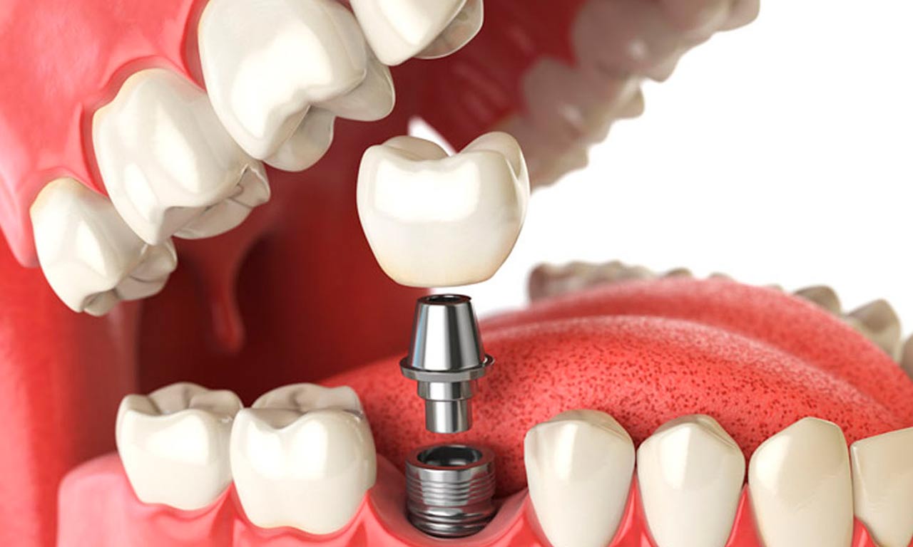 Evaporar Estimar Eficiente Complicaciones comunes en implantes dentales