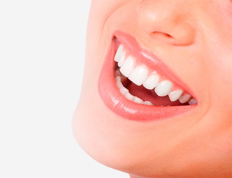 carilla de porcelana