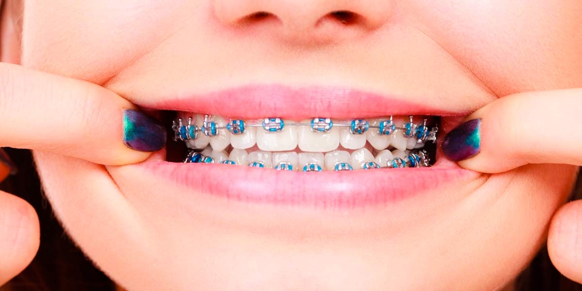 BRACKETS POR VESTIBULAR DE MATERIALES ULTRA ESTETICOS